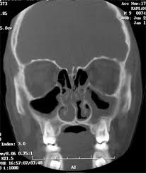 Arcüreggyulladás CT felvétele