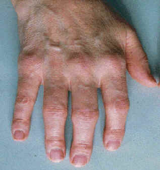 Kézen fellépő arthritisz
