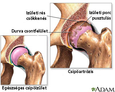 artrózis diagnosztizálása és kezelése)
