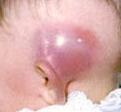 Csecsnyulvány gyulladás - a fül mögötti csecsnyúlvány a nem megfelelően kezelt középfülgyulladás miatt gyulladásba jöhet