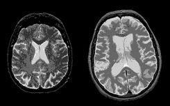 Egészséges (balra) és Huntington-kóros beteg agyának MRI felvétele. A beteg agyban a szélen lévő világos részek a károsodott területeket jelzik