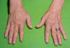 gennyes artritisz a karon