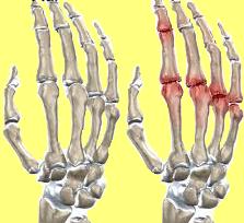 izületi kopás az ujjak akut artritiszében