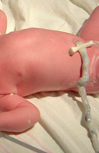 Köldökzsinór egy csecsemőn