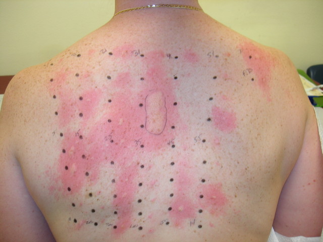allergiás kontakt dermatitis