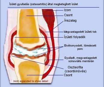 az alsó láb posztraumás artrózisának kezelése fürdők artrózis kezelésére