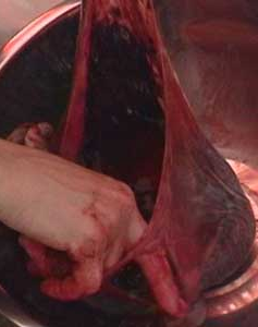 Méhlepény- terhesség során létrejövő szerv, amely összeköti az anyát a magzattal