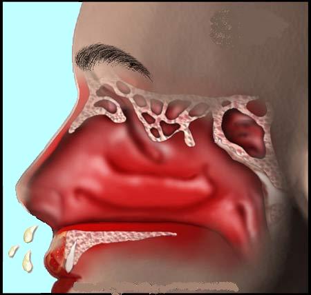 Orrnyálkahártya gyulladás - az orrüreget bélelő nyálkahártya gyulladása, mely fölös mennyiségű nyálka kiválasztásával jár