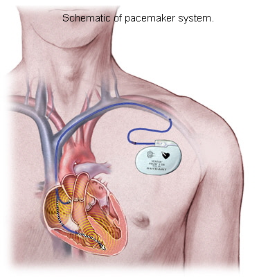 Pacemaker a szívnél