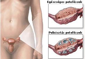 rosszindulatú ciszta Prostatitis Danas visszajelzése