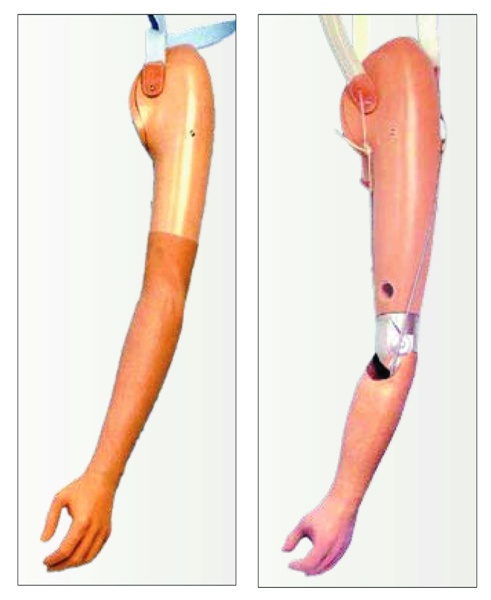 Felső végtag protézis