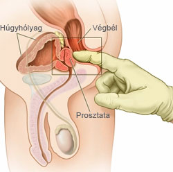 A rectalis digitalis vizsgálat jelentősége a PSA-teszt mellett
