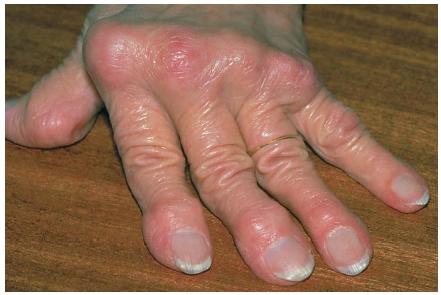rheumatoid arthritis 2. szakasz