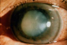 Index - Tech-Tudomány - Génterápiával sikerült részlegesen visszaállítani egy vak beteg látását