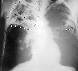 tüdő tuberkulózis gyanúja)